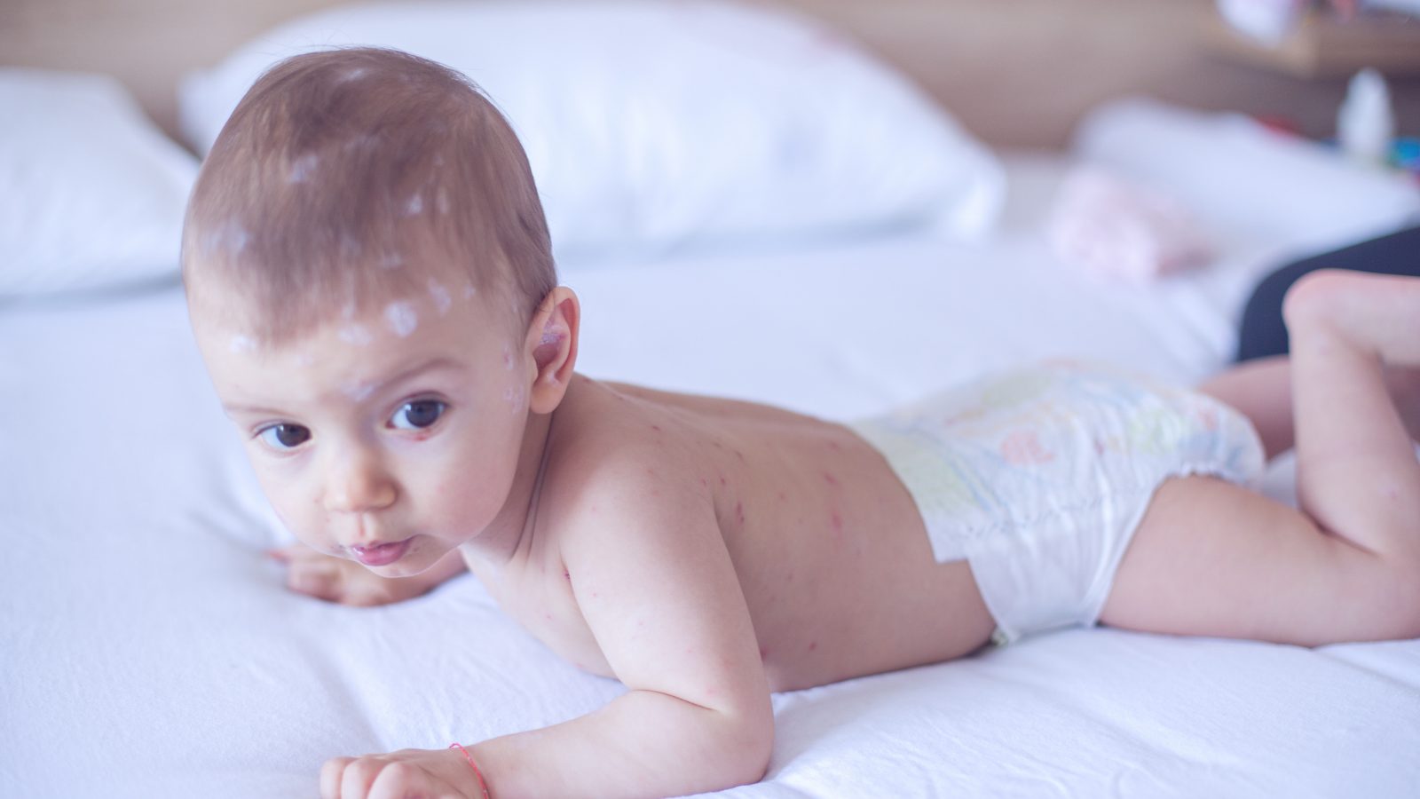 child with chickenpox